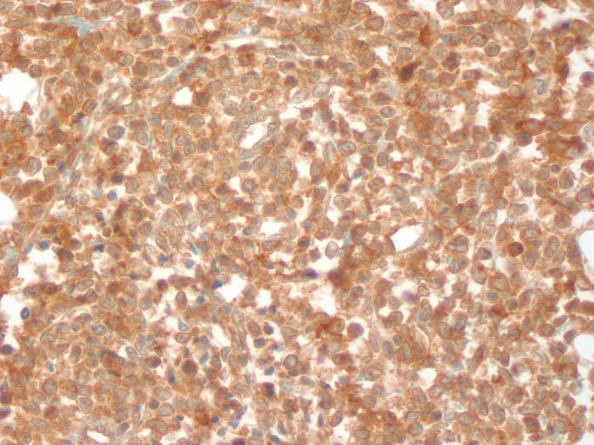 Mediastinal Mass CD33 40x